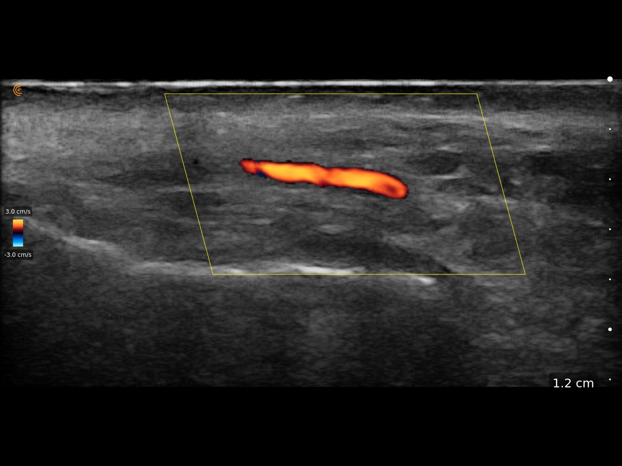 Clarius L20 - Mapeo vascular facial en estética avanzada